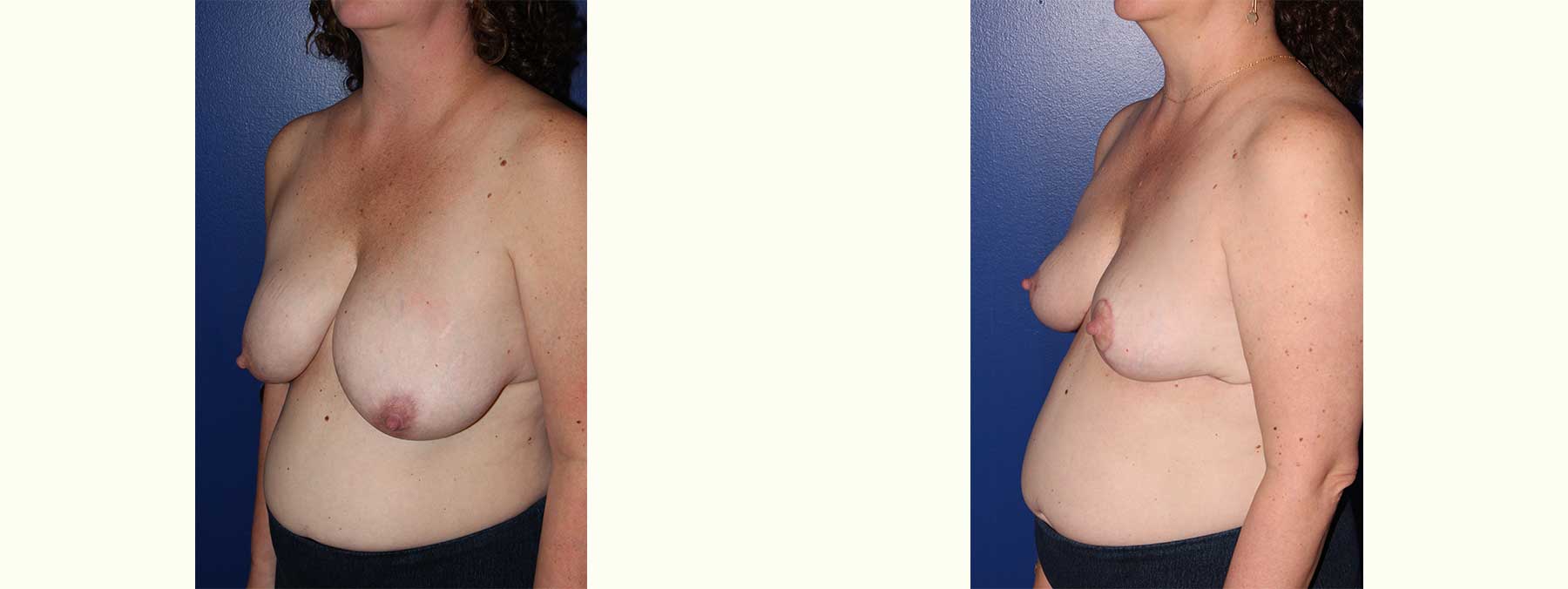 Before and After Image of Breast Reduction