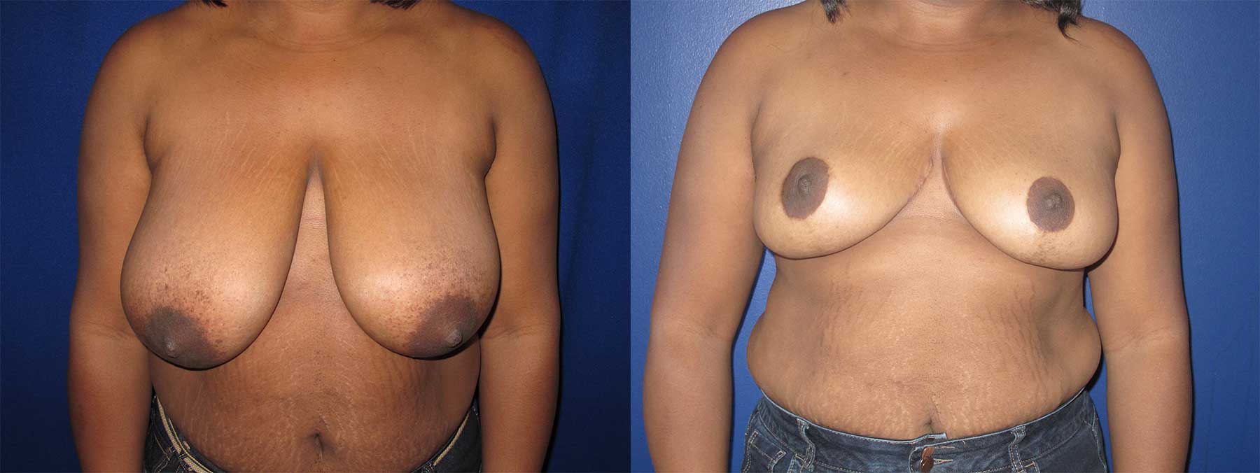 Before and After Image of Breast Reduction