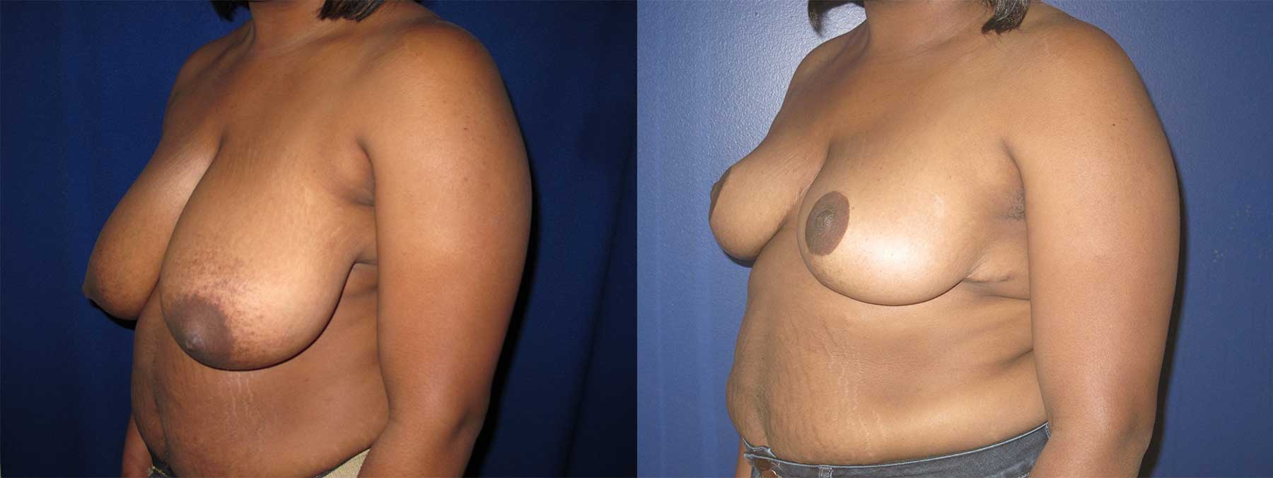 Before and After Image of Breast Reduction